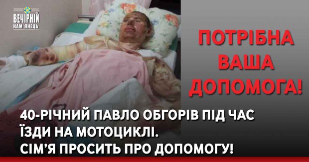 40-річний Павло обгорів під час їзди на мотоциклі. Сім’я просить про допомогу!
