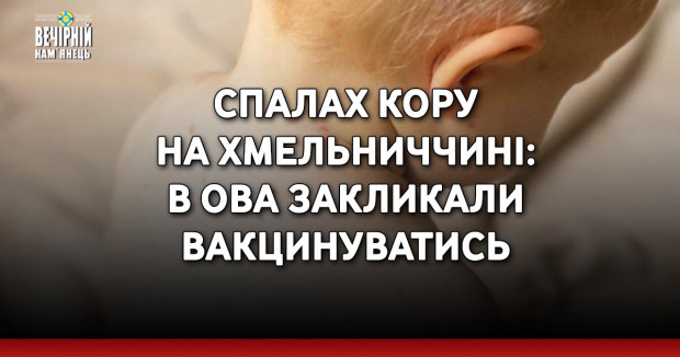 Спалах кору на Хмельниччині: в ОВА закликали вакцинуватись
